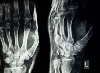 Xray of a hand